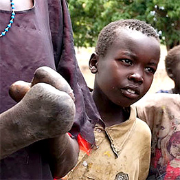 Agok Leper Colony - Sudan Relief Fund